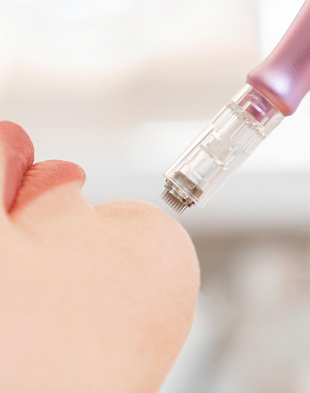 Microneedling